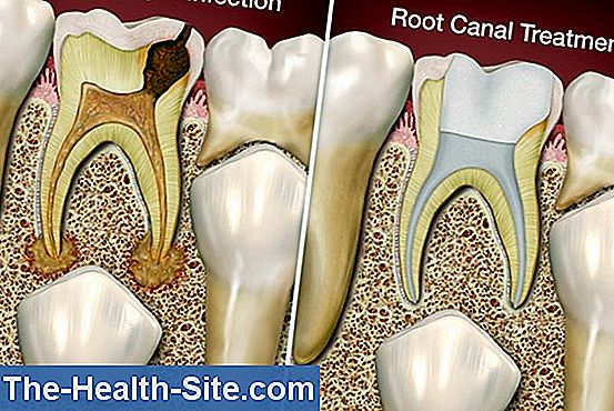 Root Rupt Treatment